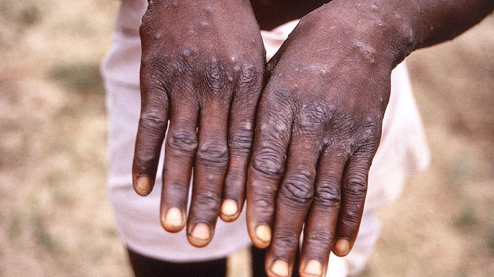 WHO set to hold emergency meeting on ‘monkeypox’ virus outbreak