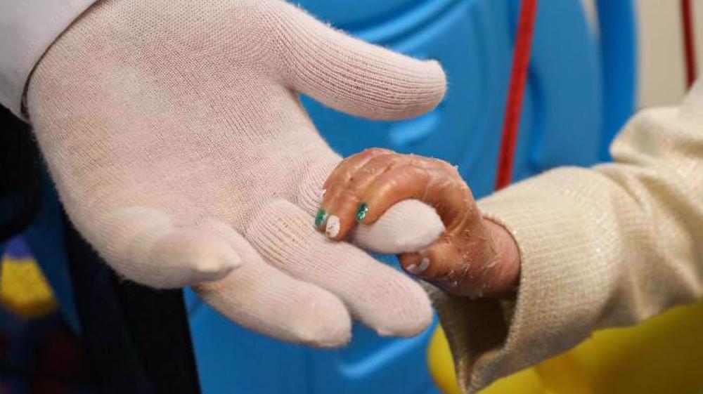 Swedish supplier denying Iran’s EB patients of bandages: Envoy