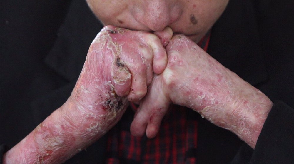 Medical terrorism of US, allies continues to take toll on Iranian EB patients