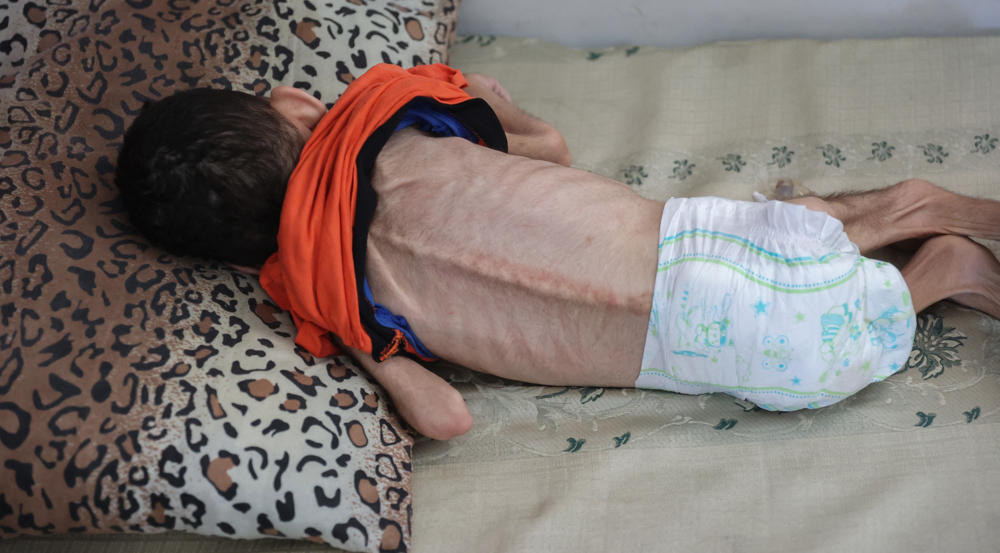 UN says 3,000 malnourished kids in Gaza dying before eyes of families