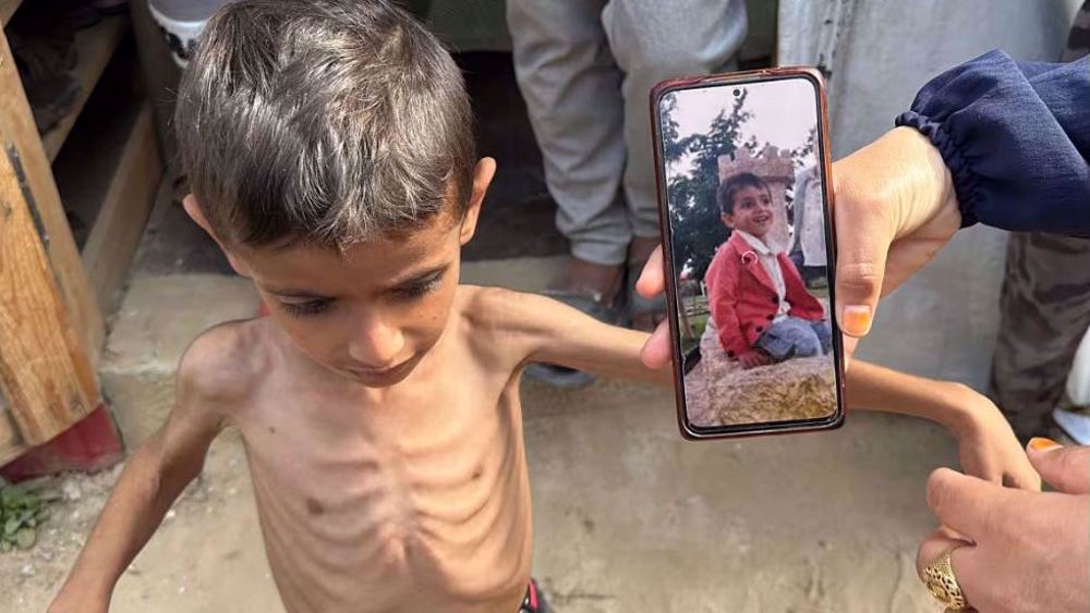 Tahrir Hospital director: Gaza children at most severe stage of malnutrition
