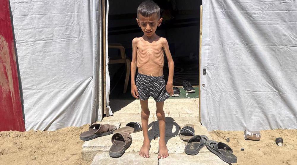 Les enfants de Gaza au stade le plus grave de la malnutrition