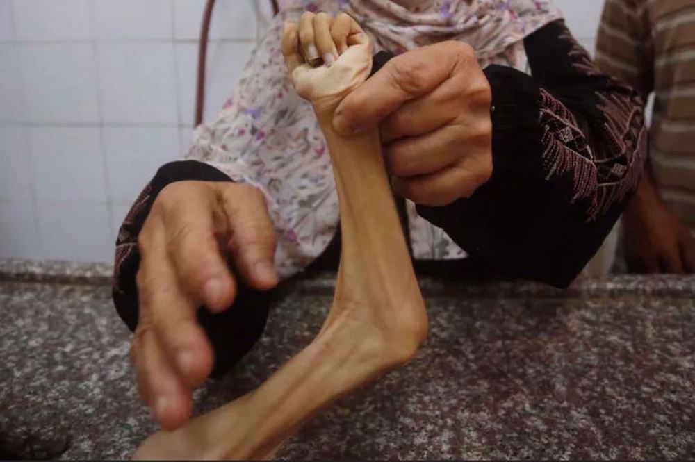 UN warns Israel starving 1 million children to death in Gaza 