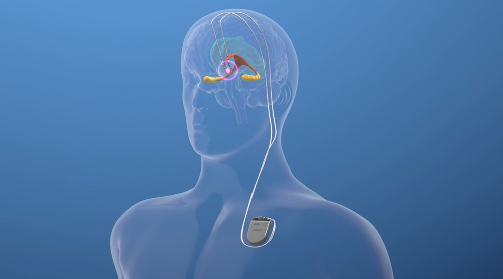 Iran’s deep brain stimulation technology for Parkinson’s treatment to enter human trials by 2027