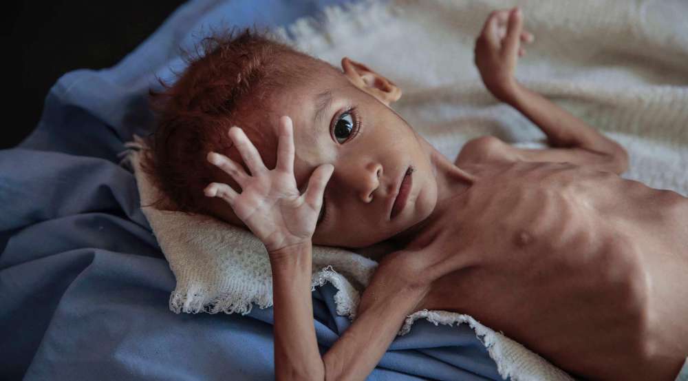 Escalating violence in Yemen displaces 71,000 children, exacerbates malnutrition: UNICEF