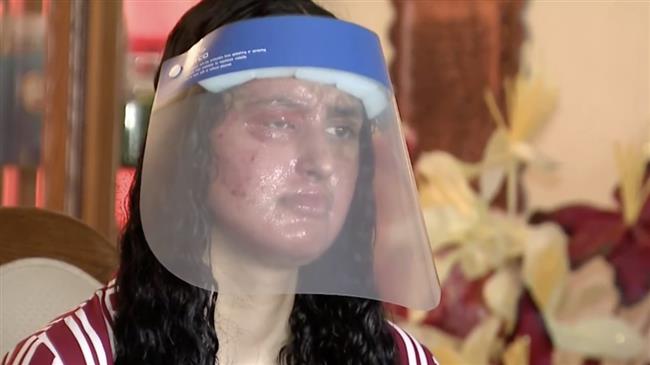 Muslim woman burned in acid attack in New York in another hate crime 