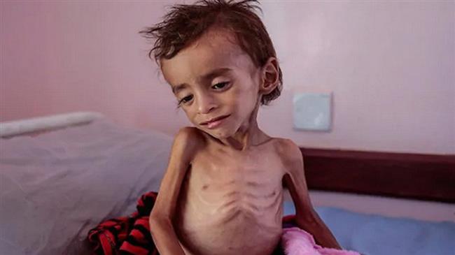 A child dies in Yemen every 10 minutes, no ‘helping hand’ from US